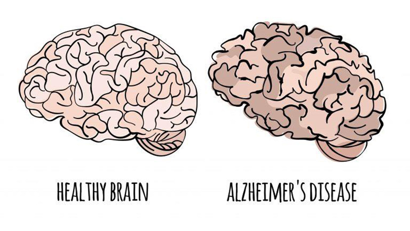 Ultrasensitive protein detection in Alzheimer's Disease